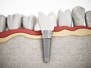 Implanty zębów koszt i rodzaje tytanowe cyrkonowe