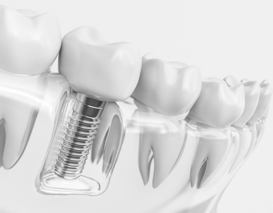 Korony cyrkonowe na implantach Toruń